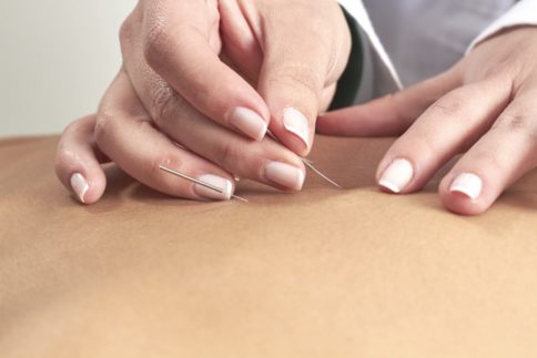 Acupuncture Cost 2019 - Best Acupuncture Near Me